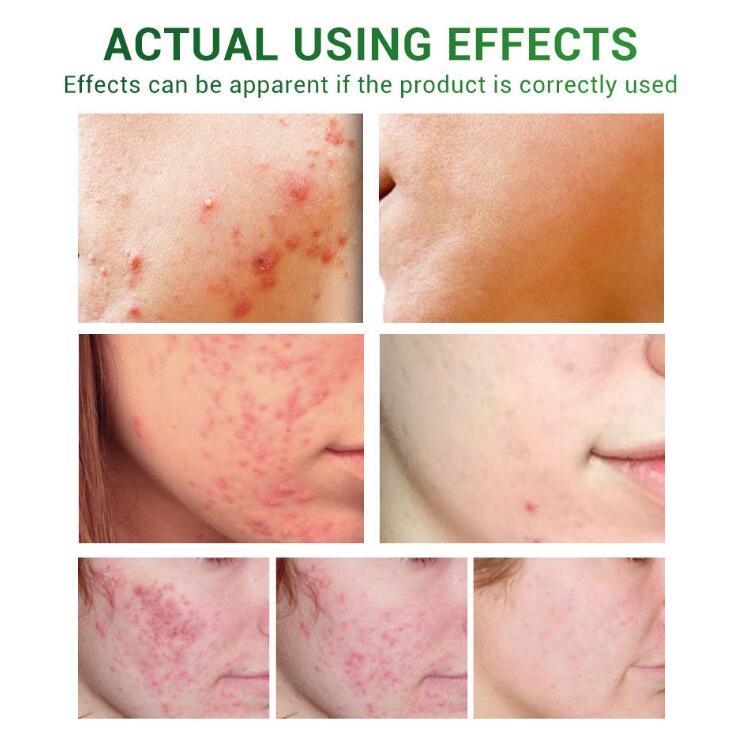 Reviorepeau Blemish Defense Serum — Reveal Confident, Radiant Skin